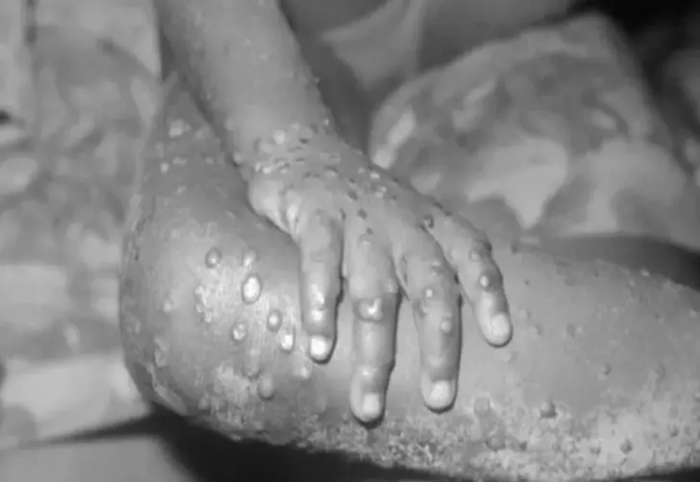 Al doilea caz de variola maimuţei a fost identificat în România