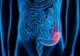Testare gratuită pentru depistarea cancerului colorectal pentru vârstnicii din parohiile bucureștene și ilfovene
